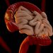 Stage 4 Colon Cancer CEA Level
