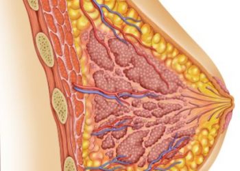 Ductal Carcinoma In Situ