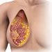 Breast Cancer Rash