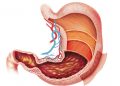 Stage 4 Stomach Cancer