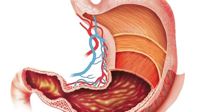 Stage 4 Stomach Cancer