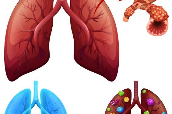 How to Cope With Metastatic Lung Cancer