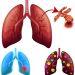 How to Cope With Metastatic Lung Cancer