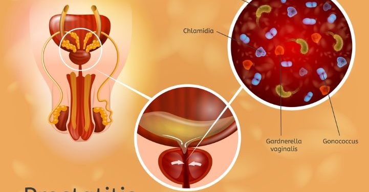 Benign Prostatic Hyperplasia