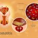 Benign Prostatic Hyperplasia