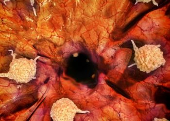 Benign Prostatic Hyperplasia