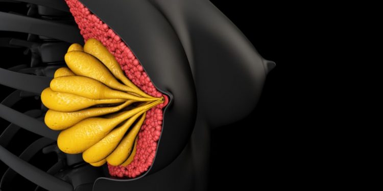 What is DCIS Breast Cancer?