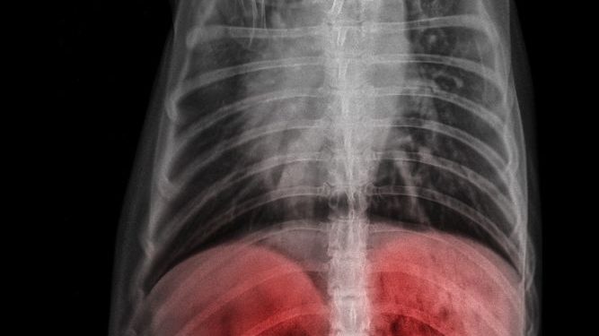 What is a Liver Tumor?