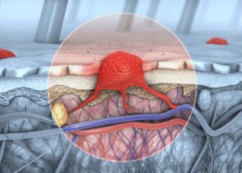What is Metastatic Cancer?