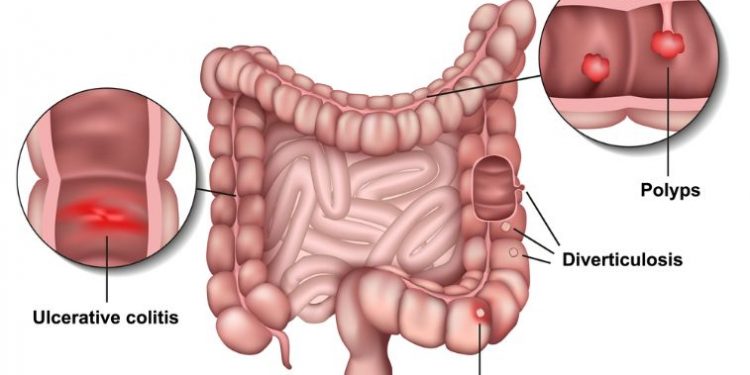 What Are Stage 4 Colon Cancer Symptoms?