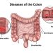 What Are Stage 4 Colon Cancer Symptoms?