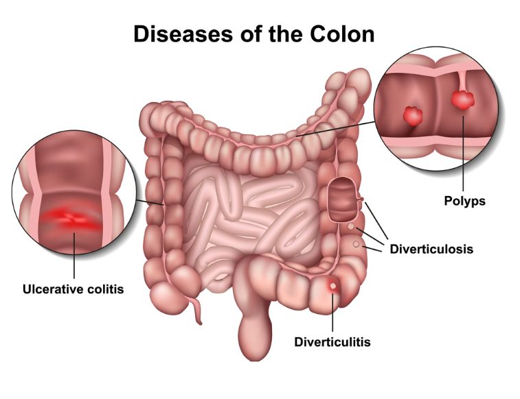 symptoms of 4th stage colon cancer