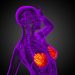 Breast Cancer in Men