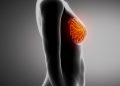 Signs of Breast Cancer in Women