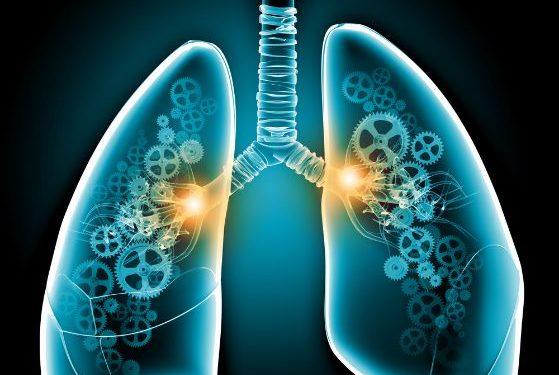 Stage 4 Lung Cancer Life Expectancy
