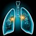 Stage 4 Lung Cancer Life Expectancy