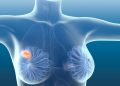 Metastatic Breast Cancer Symptoms
