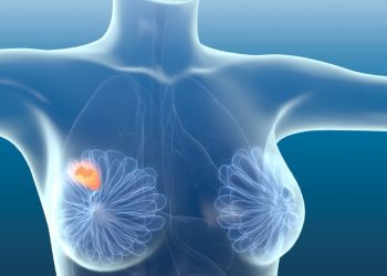 Metastatic Breast Cancer Symptoms