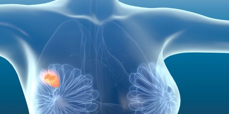 Metastatic Breast Cancer Symptoms