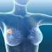 Metastatic Breast Cancer Symptoms