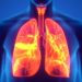 Symptoms of Lung Cancer in Females