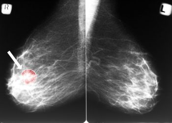 What You Need to Know About Stage 4 Breast Cancer
