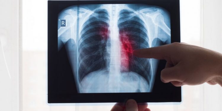 The Stage 4 Lung Cancer Survival Rate by Age