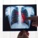 The Stage 4 Lung Cancer Survival Rate by Age