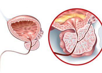 Relugolix CT For Treatment of Uterine Fibroids