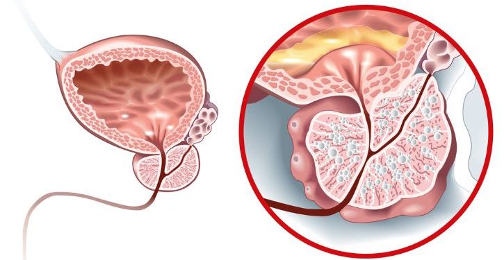 Relugolix CT For Treatment of Uterine Fibroids