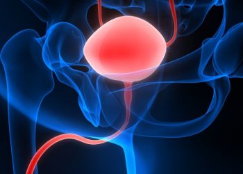 Metastatic Prostate Cancer