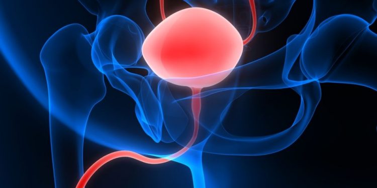 Metastatic Prostate Cancer