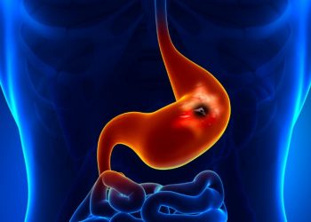 Stomach Cancer Symptoms That Don’t Go Away