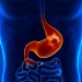 Stomach Cancer Symptoms That Don’t Go Away