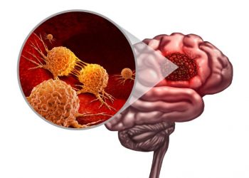 Glioblastoma Stage 4