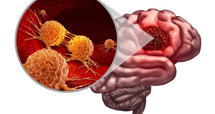 Glioblastoma Stage 4