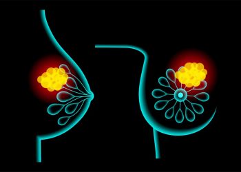 Lobular Breast Cancer