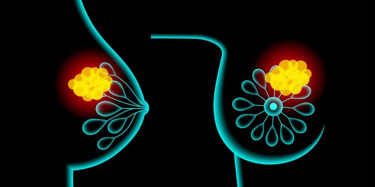 Lobular Breast Cancer