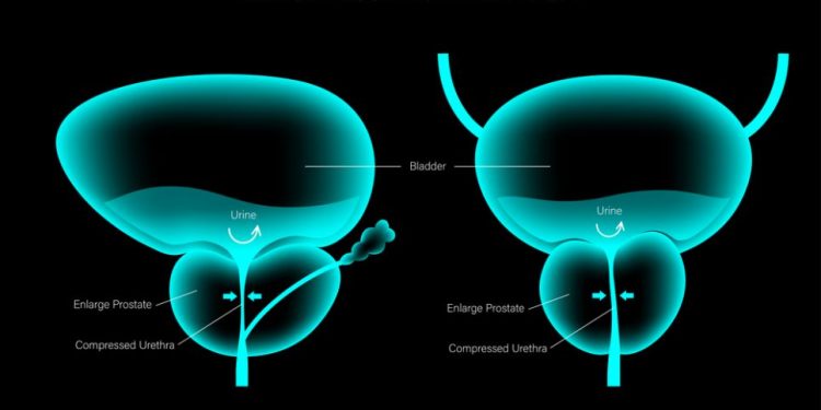 What Treatment Options Are Available For Prostate Cancer?