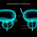 What Treatment Options Are Available For Prostate Cancer?