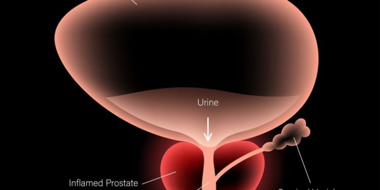 What Treatments Are Available For Stage 4 Prostate Cancer?