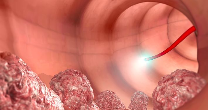 Final Symptoms of Stage 4 Colon Cancer