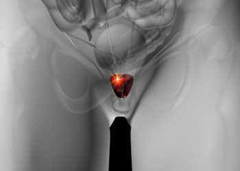 Is High PSA a Symptom of Prostate Cancer?