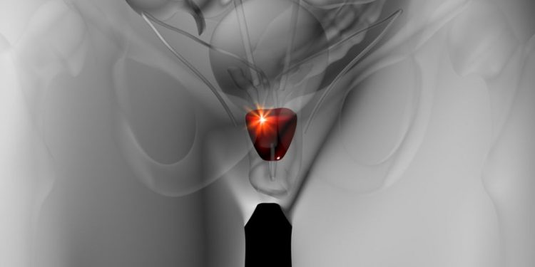 Is High PSA a Symptom of Prostate Cancer?