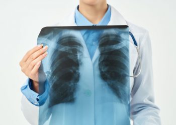 Stage 4 Non Small Cell Lung Cancer