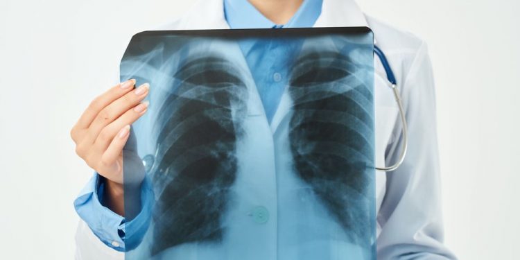 Stage 4 Non Small Cell Lung Cancer