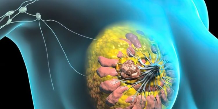 Ductal Carcinoma In Situ