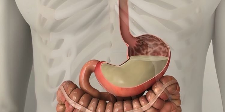 Small Bowel Obstruction Symptoms