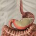 Small Bowel Obstruction Symptoms