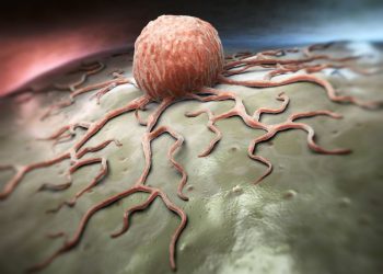 Metastatic Squamous Cell Carcinoma